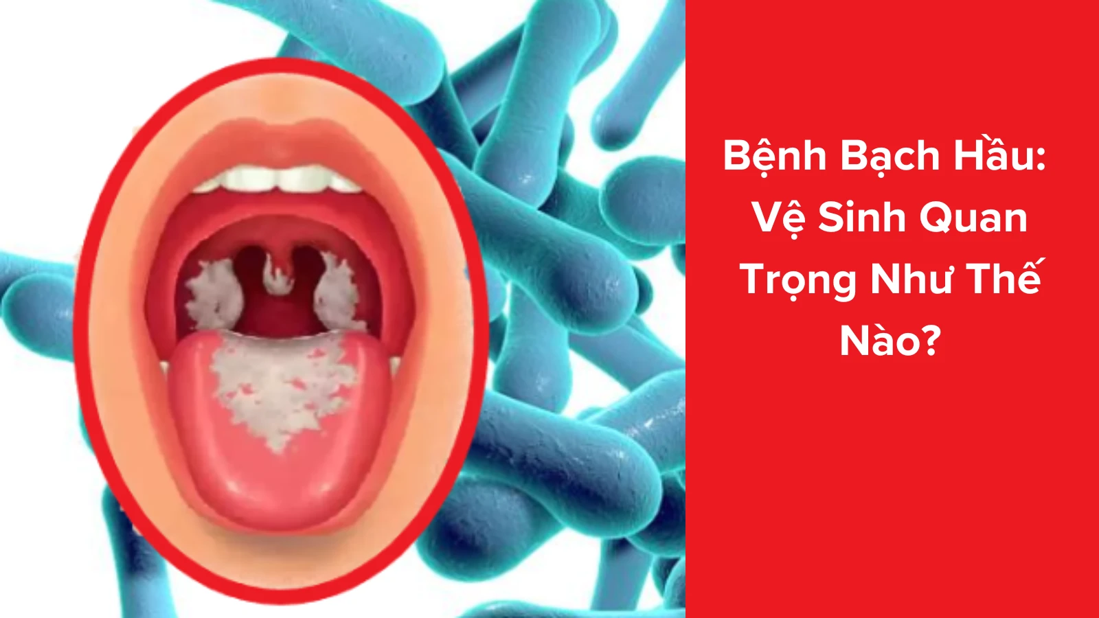 benh bach hau
