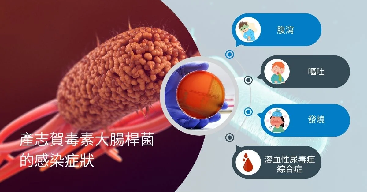 產志賀毒素大腸桿菌的感染症狀